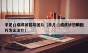 手足口病症状初期图片（手足口病症状初期图片怎么治疗）